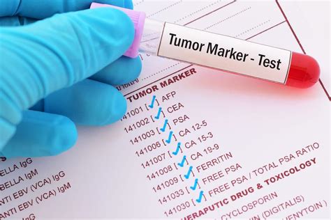 marker tumoral plamani|Markeri tumorali plamani – Indicatori pentru cancerul pulmonar